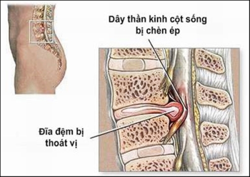 Đau Lưng Bên Trái Gần Eo: Nguyên Nhân Và Giải Pháp Hiệu Quả