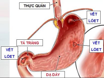 Điều trị viêm dạ dày cần một chế độ ăn hợp lý