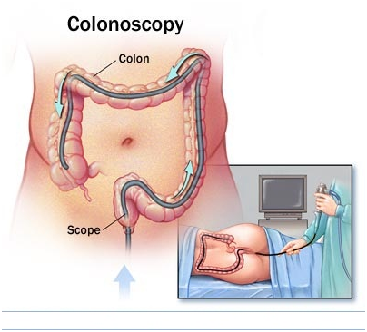 Nội soi đại tràng giúp phát hiện và chẩn đoán bệnh Crohn. bệnh crohn