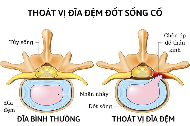 Đau dây thần kinh ở cổ cảnh báo nhiều nguy cơ bệnh lý nguy hiểm