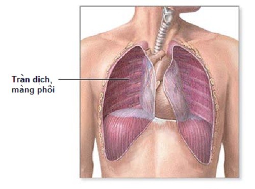 Bệnh viêm phổi và biến chứng