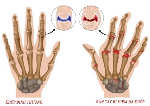 Điều trị viêm khớp dạng thấp là bệnh tự miễn.