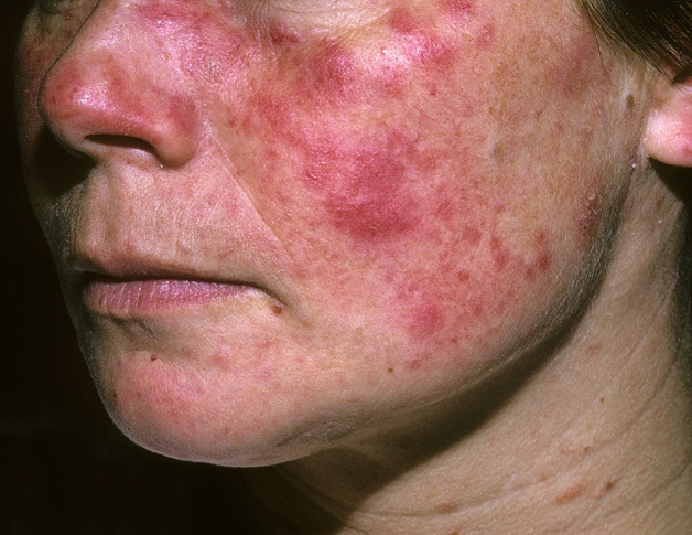 Lupus ban đỏ - nguyên nhân gây đau dây thần kinh ngoại biên