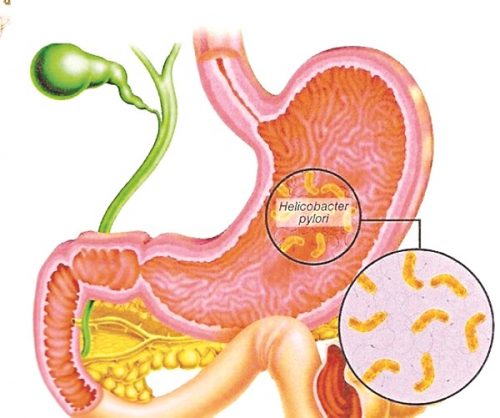 Vi khuẩn Hp được xem là một trong những nguyên nhân chính gây ra bệnh viêm loét dạ dày