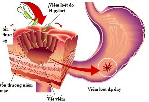 Viêm loét dạ dày tá tràng chủ yếu là do vi khuẩn HP gây ra