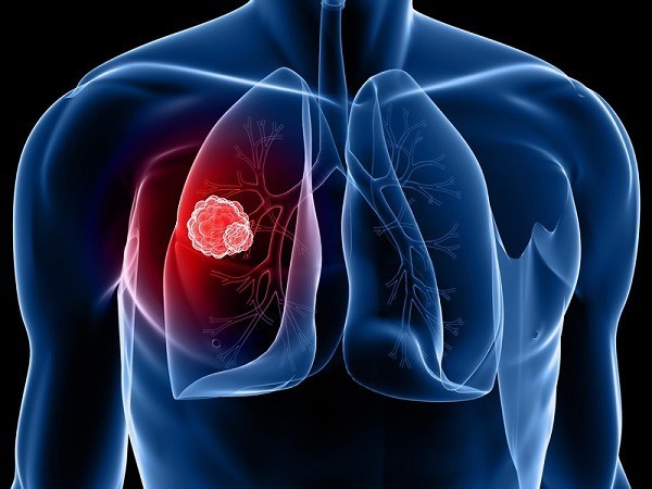 Ung thư phổi là bệnh ung thư thường gặp nhất và nguy hiểm hàng đầu.