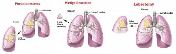 Điều trị ung thư phổi
