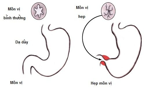 Hẹp môn vị là tình trạng lưu thông thức ăn và dịch dạ dày xuống tá tràng gặp khó khăn hoặc bị đình trệ một phần.