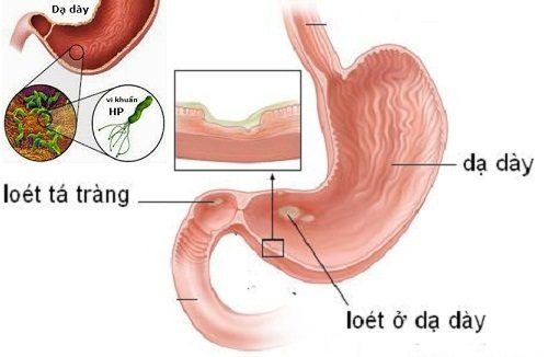 Nguyên nhân chủ yếu gây viêm loét dạ dày tá tràng là do vi khuẩn HP