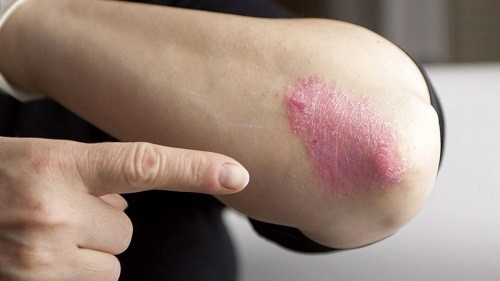 Trẻ bị vẩy nến có thể gặp phải triệu chứng như da có các mảng đỏ ranh giới rõ, phía trên có vẩy dày màu trắng.