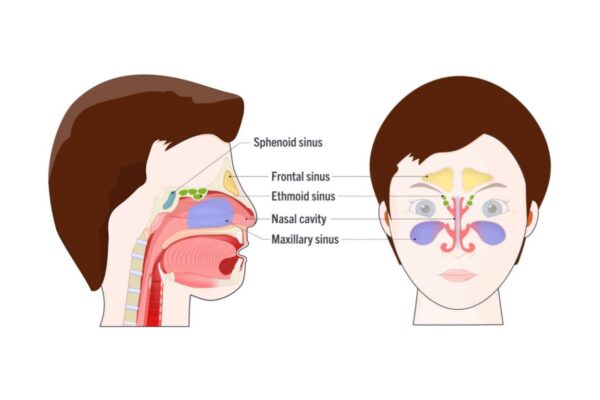 Viêm xoang xảy ra khi niêm mạc các lớp lót trong lỗ thông xoang bị viêm nhiễm do tác nhân có hại tấn công