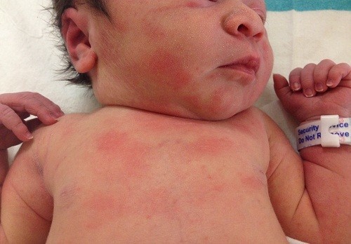 Khoảng 2 - 3 ngày sau khi chào đời, da của trẻ có thể xuất hiện những mảng ban, còn được gọi là phát ban đỏ. 