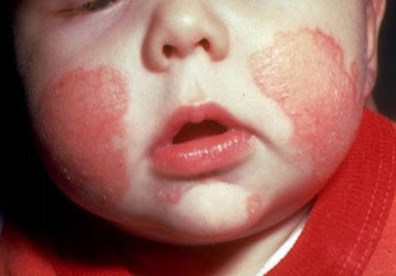 Bệnh ngoài da thường gặp ở trẻ em