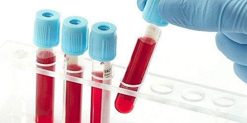 Trong chẩn đoán xơ gan, bác sĩ có thể yêu cầu người bệnh thực hiện xét nghiệm máu để đánh giá chức năng gan và thương tổn ở gan. 