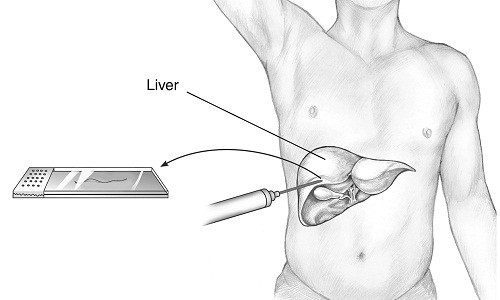 Sinh thiết gan là phương pháp chẩn đoán xơ gan trong đó một mẩu nhỏ của tế bào gan được lấy ra đem kiểm tra dưới kính hiển vi.