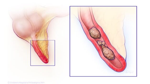 Ruột thừa là một bộ phận của ống tiêu hóa, nằm tại ngã ba ruột non – ruột già