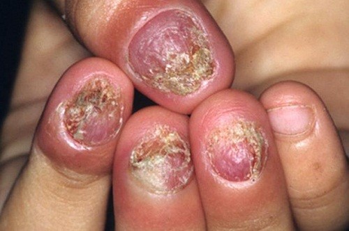 Nấm móng tay là bệnh nhiễm trùng ở móng do nấm.