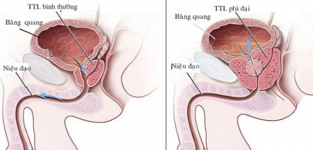 Cổ tử cung phì đại là gì là thắc mắc của nhiều chị em
