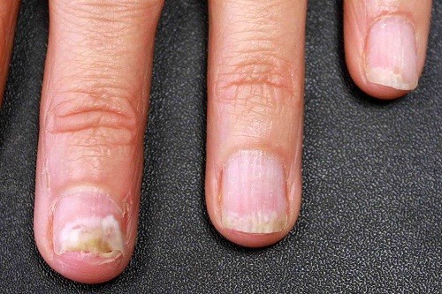 Thuốc điều trị bệnh nấm móng tay thường được chia thành hai loại là thuốc uống và thuốc bôi ngoài da.