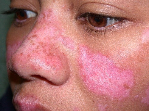 Một trong các triệu chứng điển hình của bệnh lupus ban đỏ hệ thống là nổi mẩn đỏ trên má và mũi.
