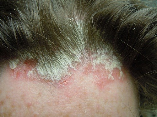 Vấn đề chữa bệnh vẩy nến da đầu là mối quan tâm hàng đầu của người bệnh.