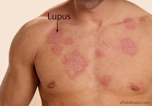 Lupus ban đỏ hệ thống thường được gọi đơn giản là bệnh lupus, là một bệnh tự miễn mạn tính.