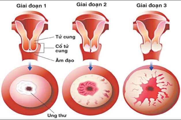 dấu hiệu ung thư cổ tử cung giai đoạn đầu