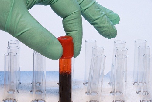 Xét nghiệm CEA (Carcinoembryonic antigen) là xét nghiệm đo mức kháng nguyên carcinoembryonic (CEA) trong máu. 