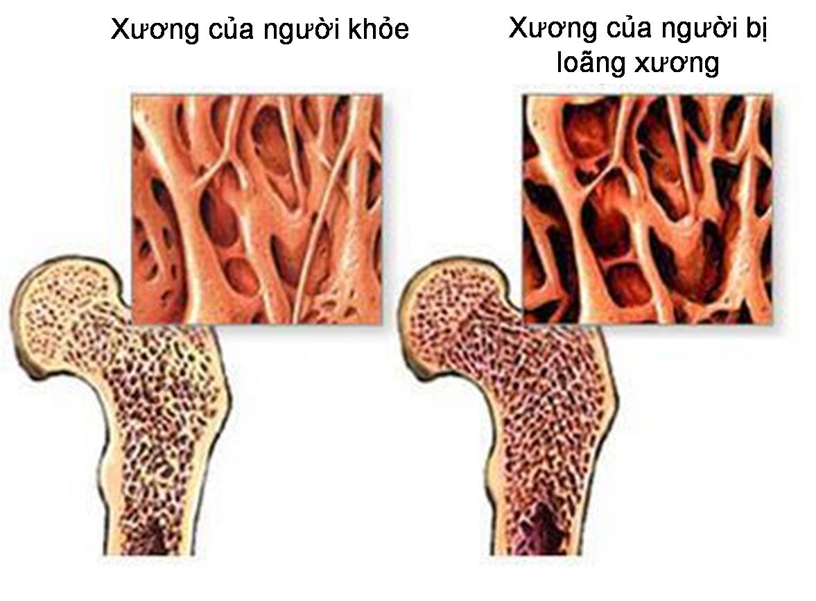 3. Phòng Ngừa Bệnh Xương Khớp Do Yếu Tố Di Truyền