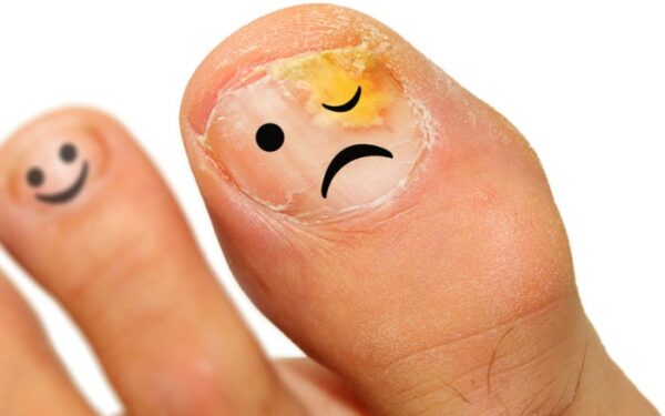 nấm móng chân ở trẻ