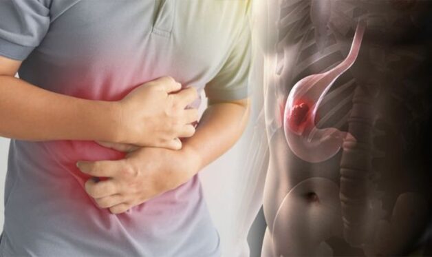 Triệu chứng của bệnh ung thư dạ dày giai đoạn cuối