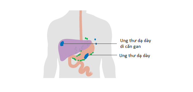 Triệu chứng của bệnh ung thư dạ dày giai đoạn cuối