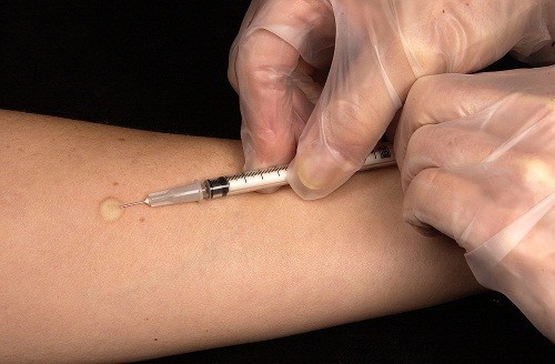Xét nghiệm lao qua da được sử dụng để kiểm tra xem một người có vi khuẩn lao trong cơ thể hay không. 