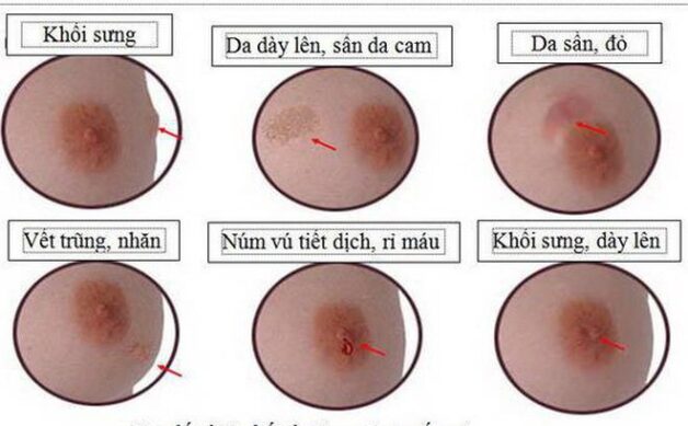 Tiên lượng bệnh ung thư vú giai đoạn đầu