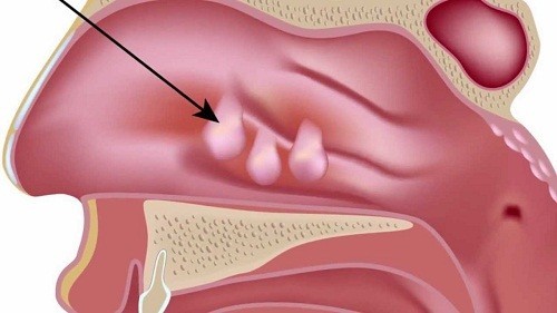 Polyp mũi là một khối u lành tính thường gặp trong hốc mũi hình thành từ lớp niêm mạc của mũi hoặc trong các xoang. 