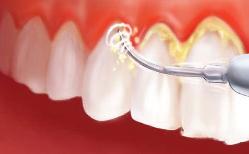 Công nghệ cạo vôi răng tiên tiến nhanh chóng làm sạch các mảng bám chân răng đem lại hiệu quả tối ưu.