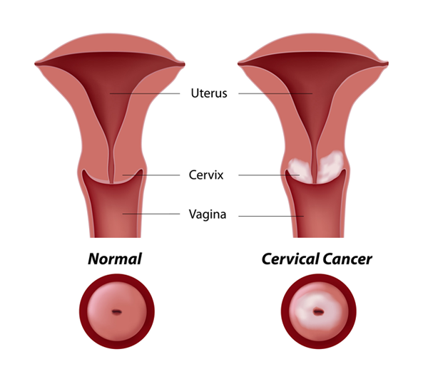 Giải đáp một số câu hỏi thường gặp về ung thư cổ tử cung