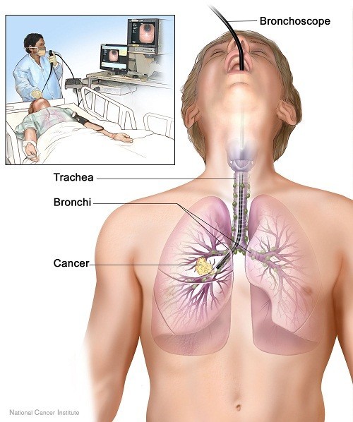 Nội soi phế quản là một trong những xét nghiệm được sử dụng để xác định nguyên nhân gây ho ra máu.