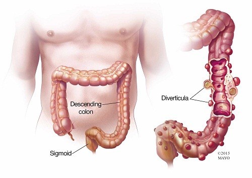 Viêm túi thừa: nguyên nhân, triệu chứng và điều trị