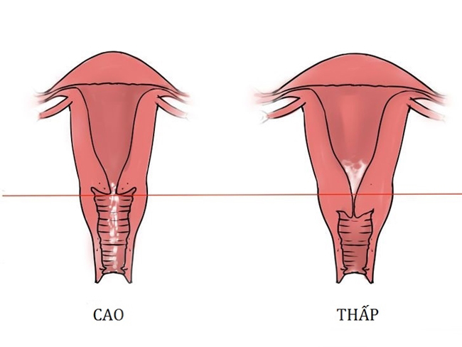 Vị trí cổ tử cung bất thường chắc chắn sẽ ảnh hưởng đến thiên chức làm mẹ của chị em phụ nữ.