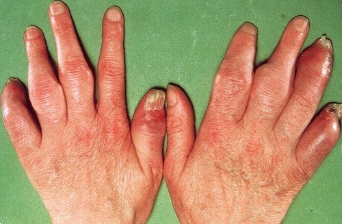hoi-dap-ve-benh-viem-khop-vay-nen2