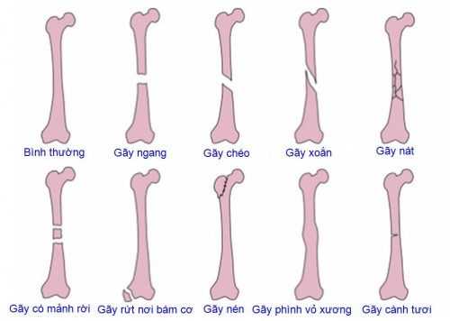 Các trường hợp gãy xương