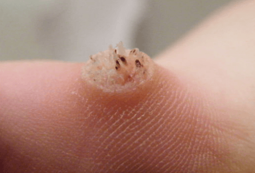 Bệnh sùi mào gà dễ nhầm lẫn với Tiền đình u nhú Papillomatosis