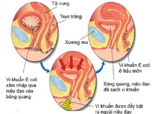 Viêm đường tiết niệu trên và dưới