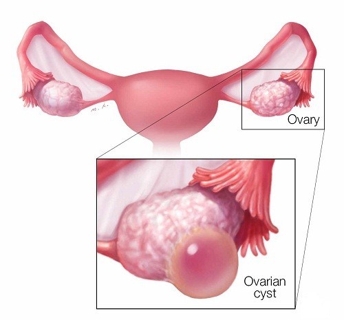 Thực chất u nang là túi chứa đầy dịch phát triển ở một hoặc cả hai bên buồng trứng.