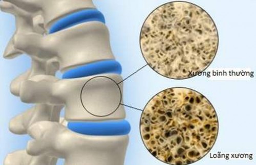 Loãng xương là một tình trạng trong đó các xương trở nên nhẹ hơn và nhiều khả năng bị gãy xương