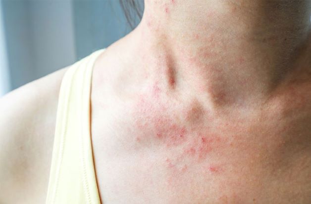 Bị dị ứng thức ăn có thể gây nên mệt mỏi và buồn nôn