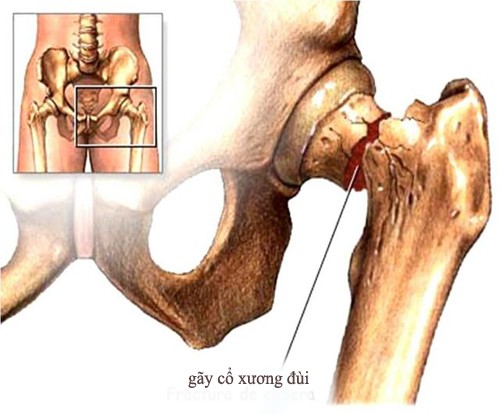 Hoại tử vô khuẩn chỏm xương đùi là gì?