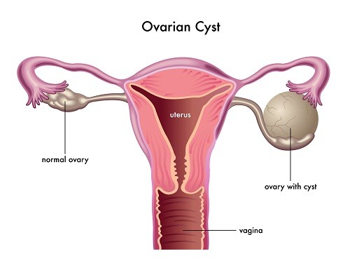 U nang buồng trứng thực chất là một túi chứa đầy dịch lỏng phát triển trên buồng trứng của người phụ nữ, đặc biệt là những người trong độ tuổi sinh đẻ. 