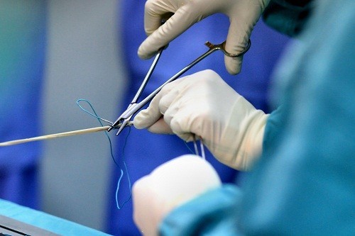 Tạo hình dây chằng chéo trước khớp gối qua phẫu thuật nội soi tại bệnh viện Thu Cúc diễn ra trong thời gian ngắn, giúp người bệnh phục hồi nhanh chóng. 